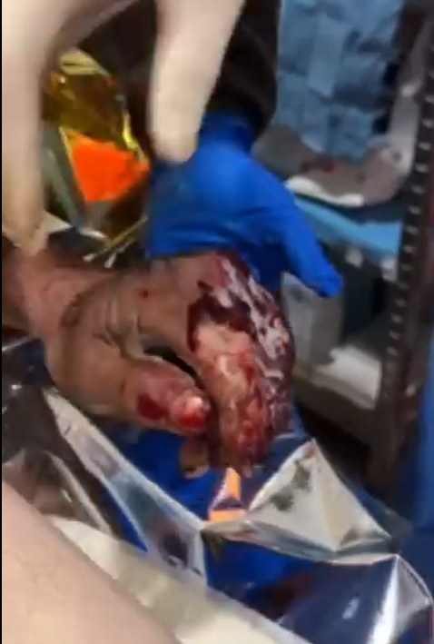 Alona shares a picture of a soldier suffering from severe frostbite, a condition that could have been prevented with a thermal blanket.